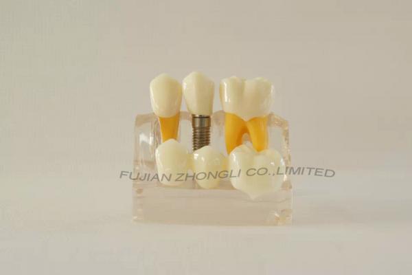 Cheap Dental Implant 3 Unit Bridge 3 Crowns Set of 6 Parts Model 4 Times Life-Size Reconstruction for sale