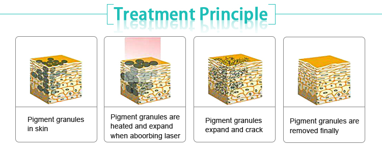 2ns Q-swtiched yag laser pigmentation removal laser freckle removal machine