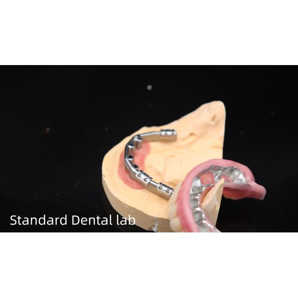 Titanium Implant Supported Dentures Precise Ivoclar Denture Over Implants