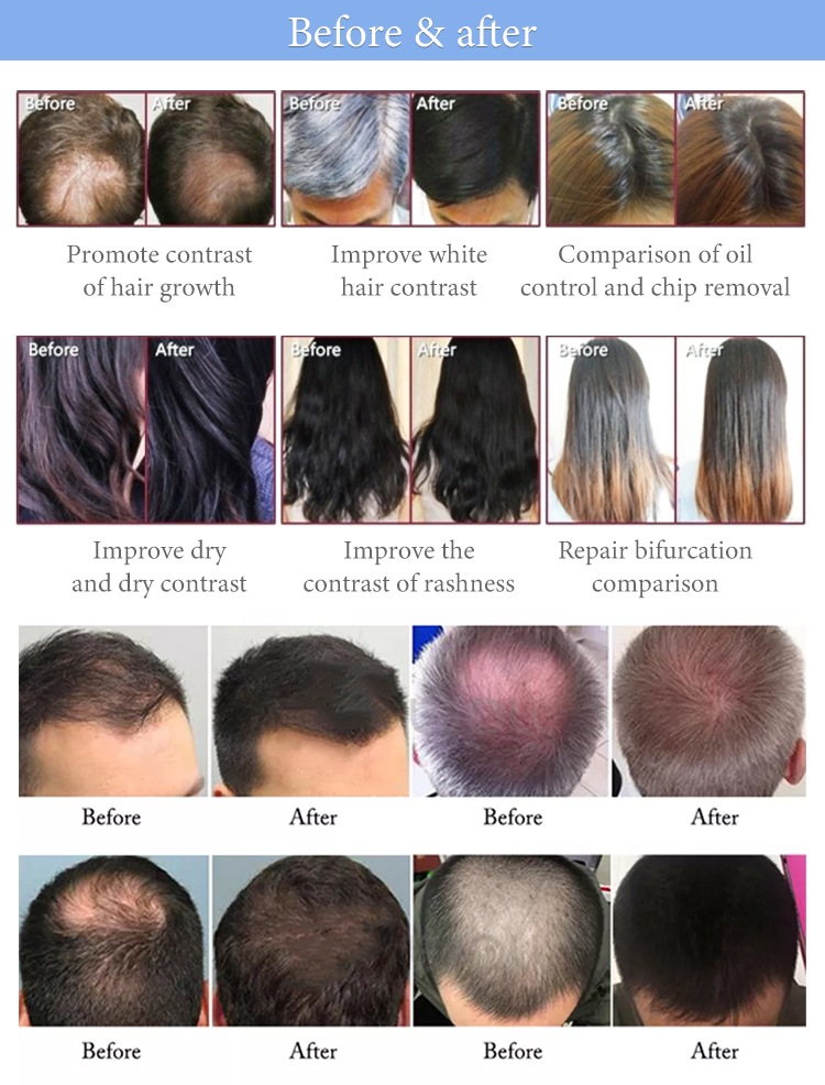 Salon Infrared Hair Loss Treatment Machine Multifunctional For Acne Removal