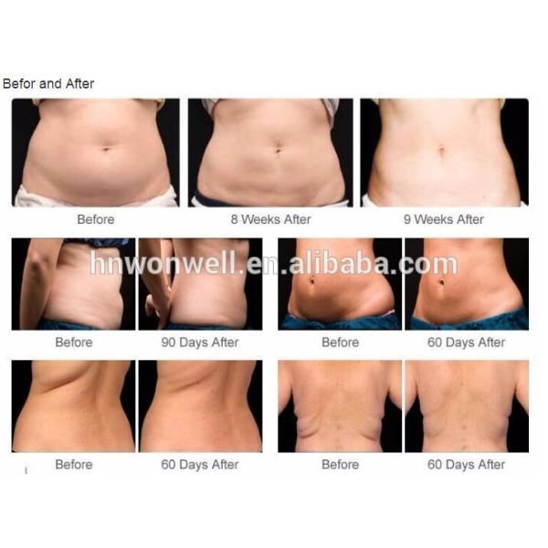 2017 Hottest fat freezing liposuction machine