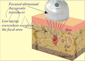 HOT SELLING!!! portable HIFUSHAPE SIMMING MACHINE FOR WEIGHT LOSS