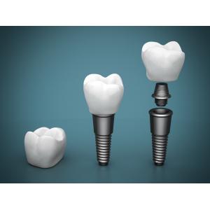 Duable Dental Implant Screw Set Titanium Medical Screw