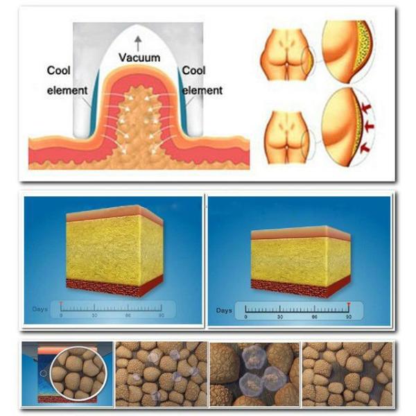 Medical CE approval Cryolipolysis+Vacuum 2 Handles Body Sculpting Machine MED-340