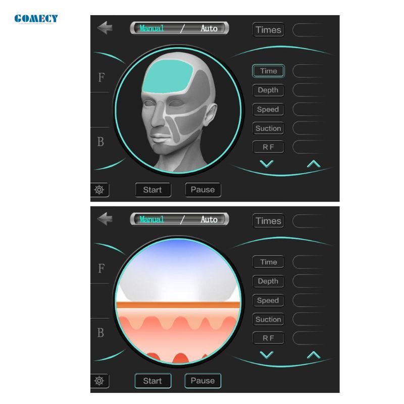 Fractional Microneedling Radio Frequency Machine for Pore Minimizing Skin Smoothing and Lifting