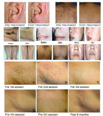 Light removal Lip Hair Beard Armpit diode laser 808 hair removal machine