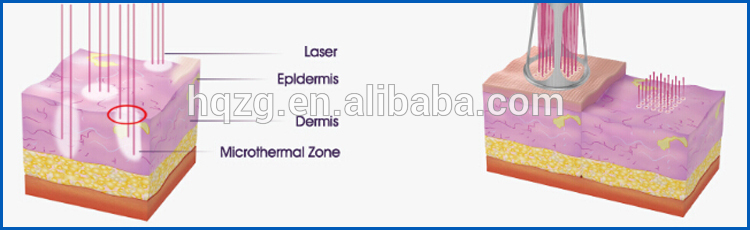 CE Approved CO2 Laser Scar Removal Machine Stable With Long Working Life