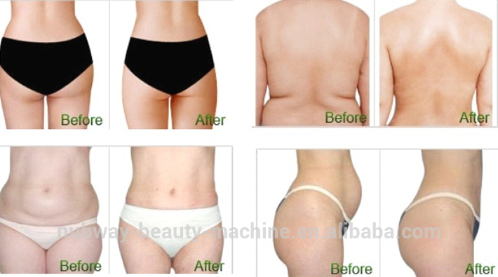 Non-Surgical Cryolipolysis Slimming Beauty Equipment(1).jpg