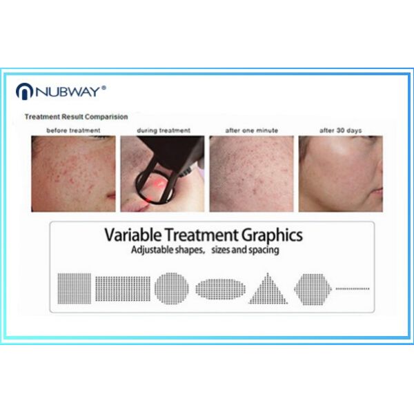 30w Fractional Co2 Laser Nubway Products Vaginal Applicator