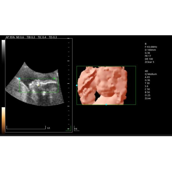 Zoncare 3D/4D Trolley Medical Digital Color Doppler Ultrasound System for Hospital