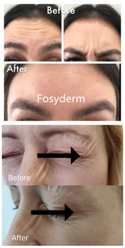 Cross Linked Wrinkle Dermal Filler Hyaluronic Acid Facial Filler Injection 1ml Fine Line