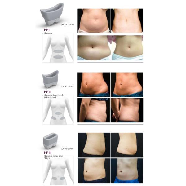 Cryolipolysis Machine Fat Freezing Slimming Machine 5 Handles 360 cryo fat reduction