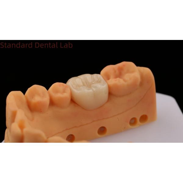 Translucency Zirconia Dental Inlay Onlay Crown For Restore Natural Cavity Shape / Standard Dental Lab