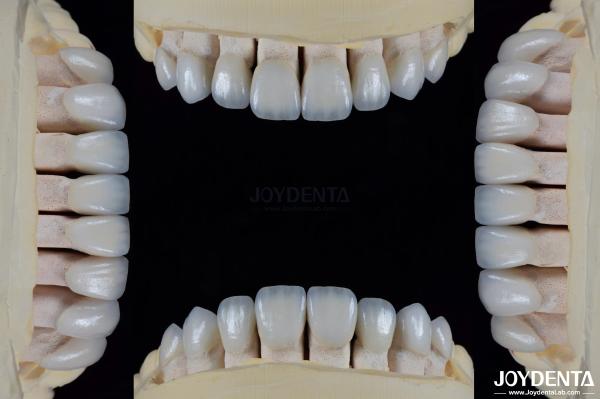 Ceramic For Natural Aesthetics Dental Veneers Stain Resistance Maintains