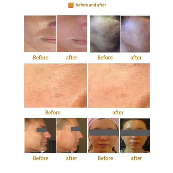 LDM Ultrasound Machine Removing Facial Swelling Skin Salon Beauty Equipment