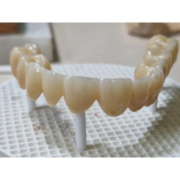 41% Translucency HT Plus Zirconia Block Fits Snugly Into The Tooth Preparation
