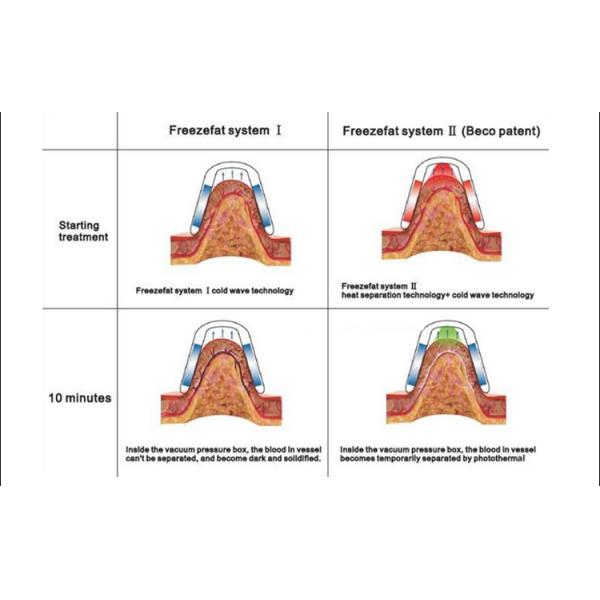 4 Handles Cryolipolysis Machine , Fat Freezing Weight Loss Machine