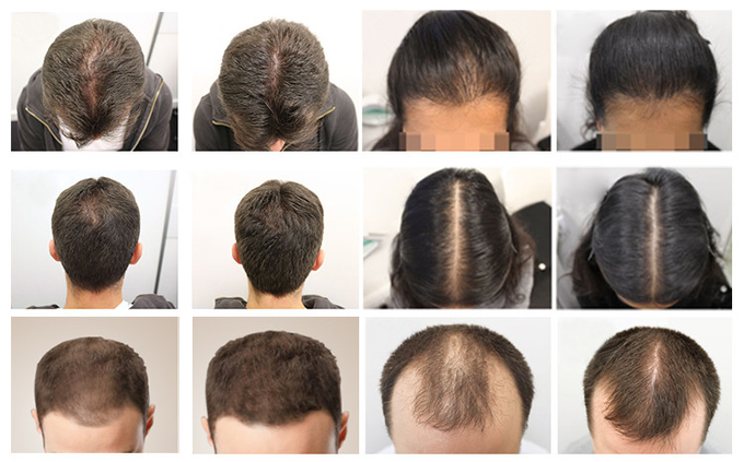 Professional 650nm LED Hair Growth System - Enhances Hair Regrowth & Scalp Health