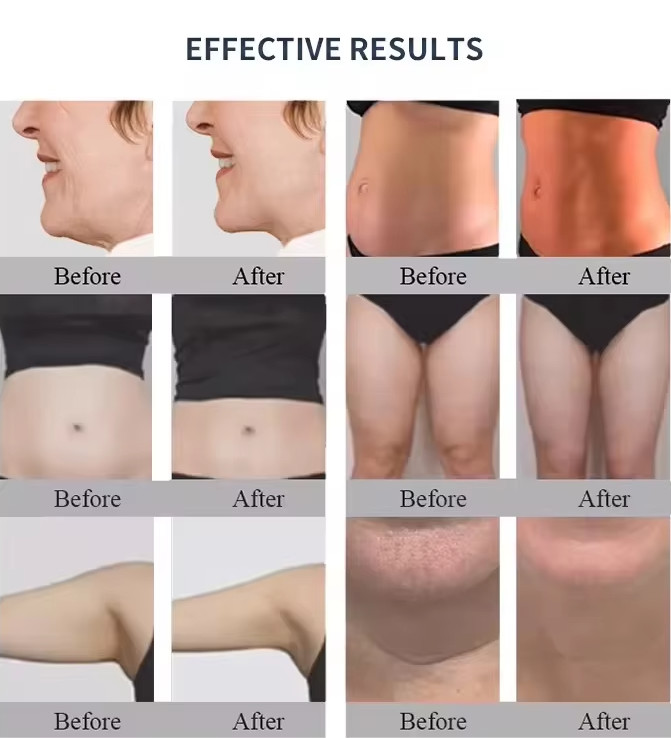 Non invasive RF Trusculpt Face Lifting Fat Burning Body Slimming Machine
