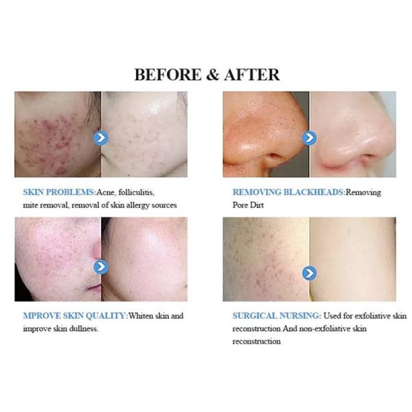 Vertical Hydro 14 in 1 Microcurrent Peeling Facial Care Dermabrasion Device
