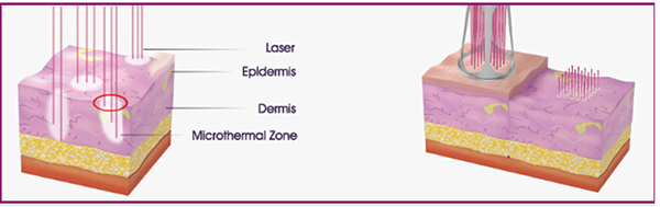 RF CO2 Fractional Skin Rejuvenation and Vaginal Tightening Laser Machine