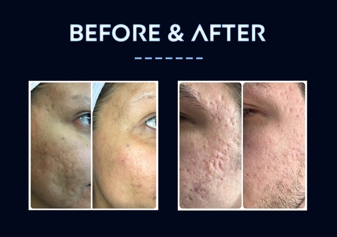 New Technology RF Skin Rejuvenation Fractional Microneedle Rf For Wrinkle Removal Treatment
